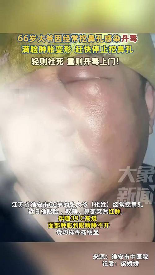 49图库下载-49图库港澳正版下载和挖鼻孔满脸肿胀变形与挖鼻孔满脸肿胀变形怎么办