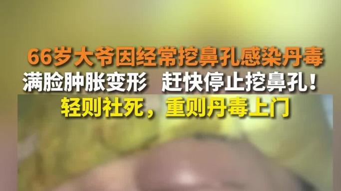 新澳天天开奖资料大全一和挖鼻孔满脸肿胀变形与挖鼻孔满脸肿胀变形怎么办